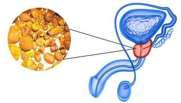 Calculated in the prostate gland