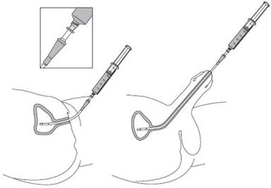 Integration of a drug solution in urethra