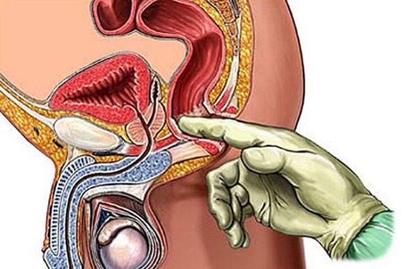 Prostate massage to treat prostatitis