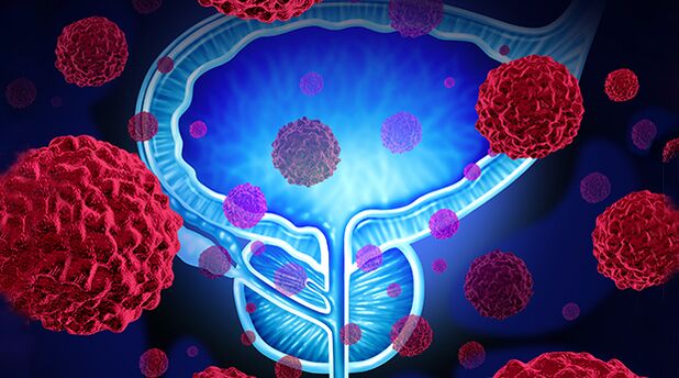 Bacteria as the cause of prostatitis