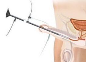 Instillations in prostatitis