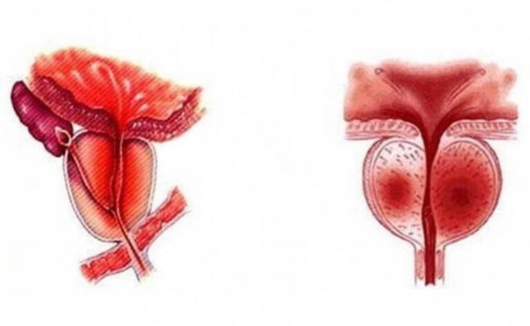 Acute inflammation of the prostate that can become chronic