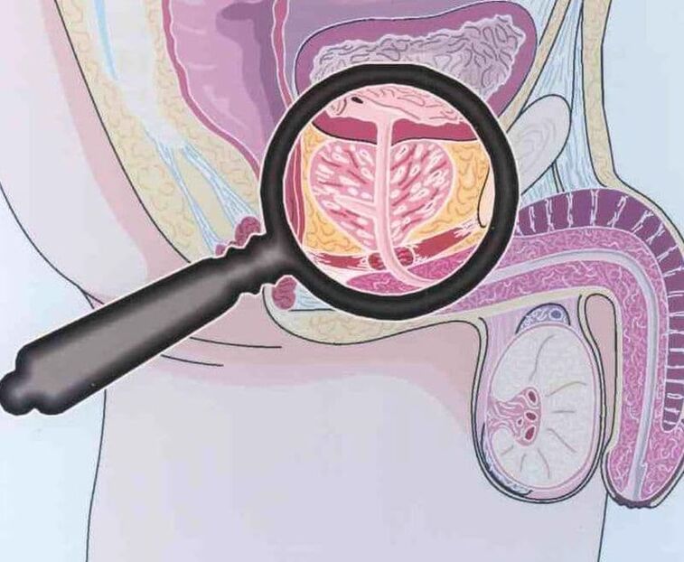 Involvement of prostate tissue in men with chronic prostatitis