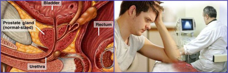 To diagnose chronic prostatitis in men, an ultrasound of the prostate is performed. 