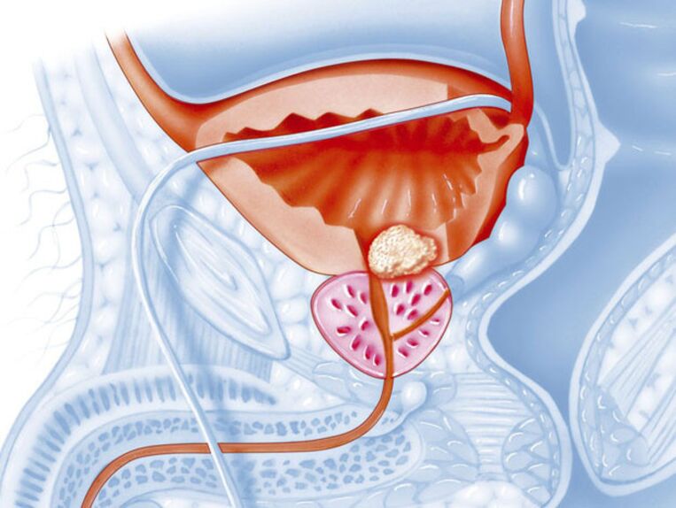 With chronic prostatitis, the lumen of the urethra narrows, which makes it difficult for urine to drain. 